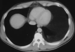 Pleural Lipoma Simulates A Pleural Effusion - CTisus CT Scan