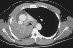 Small Cell Cancer Encases Right Mainstem Bronchus - CTisus CT Scan