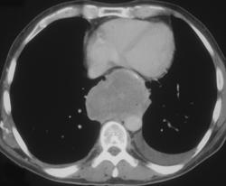 Posterior Mediastinal Pancreatic Pseudocyst - CTisus CT Scan