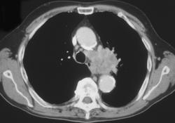 Small Cell Cancer Invades Ap Window - CTisus CT Scan