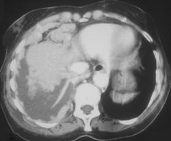 Thymoma With Implants - CTisus CT Scan