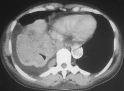 Invasive Thymoma - CTisus CT Scan