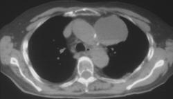 Dermoid (primary Mediastinum) - CTisus CT Scan