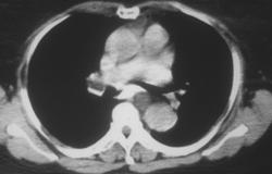 Duplication Cyst Esophagus - CTisus CT Scan