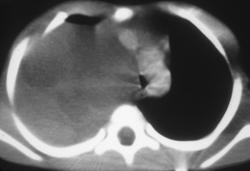 Neurofibroma - CTisus CT Scan