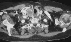 Parathyroid Adenoma - CTisus CT Scan