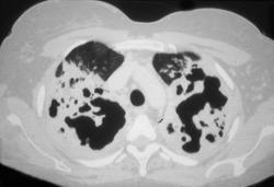 Invasive Aspergillosis - CTisus CT Scan