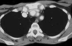 Takayasu's Arteritis - CTisus CT Scan