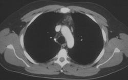 Thymic Hyperplasia in A 45 Year Old - CTisus CT Scan