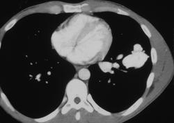 Pulmonary Arteriovenous Malformation (AVM) - CTisus CT Scan