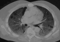 Pulmonary Congestion - CTisus CT Scan