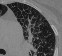 Lymphangitic Spread - CTisus CT Scan