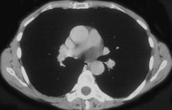 Intrapericardial Bronchogenic Cyst - CTisus CT Scan
