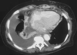 Lymphoma Infiltrates Heart - CTisus CT Scan