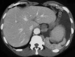 Pleural Implants - CTisus CT Scan