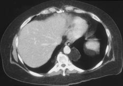 Bronchogenic Cyst - CTisus CT Scan