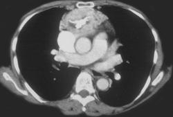 Mediastinal Germ Cell Tumor - CTisus CT Scan