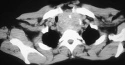 Substernal Thyroid - CTisus CT Scan