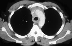 Infiltrating Lymphoma - CTisus CT Scan