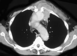 Chest Wall Abscess S/P Medial Sternotomy and A Pseudoaneurysm - CTisus CT Scan