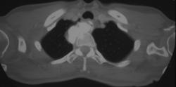 Osteosarcoma Primary in the Mediastinum - CTisus CT Scan