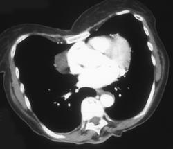 Pericardial Cyst - CTisus CT Scan