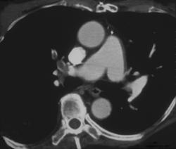 Pe - CTisus CT Scan