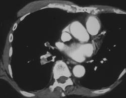 Pe - CTisus CT Scan