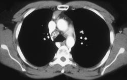 Calcified Mediastinal Nodes S/P Radiation Therapy - CTisus CT Scan