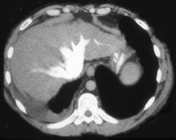 Decreased Cardiac Function - CTisus CT Scan