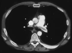 Pe - CTisus CT Scan