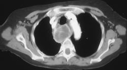 Ectopic Parathyroid Adenoma - CTisus CT Scan