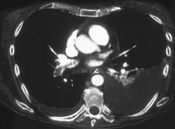 Pe - CTisus CT Scan