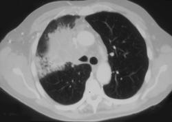 Lung Cancer With SVC Occlusion - CTisus CT Scan