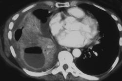 Empyema - CTisus CT Scan