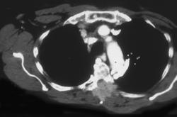 Superior Intercostal Vein- Note: Metastases to Spine - CTisus CT Scan