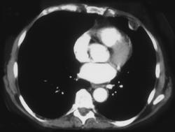 Pleural Lipoma - Chest Case Studies - CTisus CT Scanning