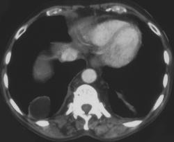 Bochdalek Hernia - CTisus CT Scan