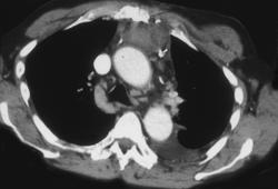 Post Op Mediastinal Hematoma - CTisus CT Scan