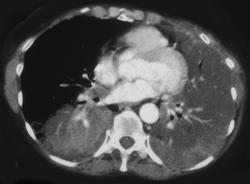 Bronchoalveolar Cell Carcinoma - CTisus CT Scan