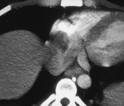 Clot in Right Atrium - CTisus CT Scan