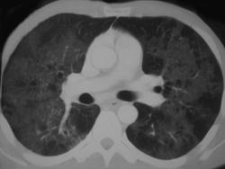 PCP (AIDS Patient) - CTisus CT Scan