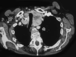 Substernal Thyroid - CTisus CT Scan