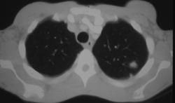 Solitary Nodules Which Was An Abscess (staph) at Removal - CTisus CT Scan