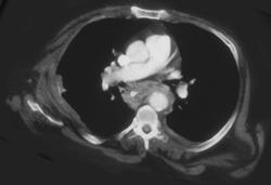 Esophageal Cancer Compresses and Invades Trachea - CTisus CT Scan