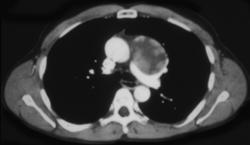 Primary Seminoma of the Mediastinum - CTisus CT Scan