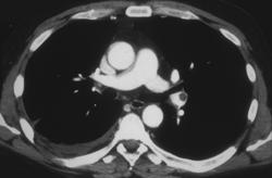 Pe - CTisus CT Scan