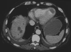 Myocardial Infarct Left Ventricle - CTisus CT Scan