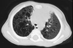 Eosinophilic Granuloma - CTisus CT Scan