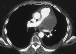 Small Cell Carcinoma - CTisus CT Scan